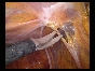 ADHESIONS BOWELS OMENTAL5 ADHESIONS BOWELS OMENTAL5